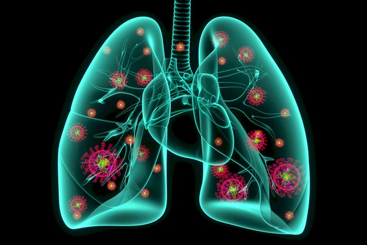 SĂNĂTATE: Pneumonia bacteriană: factori de risc, simptome, diagnostic şi tratament